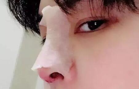 隆鼻術(shù)后的恢復(fù)期過程以及注意事項