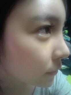 隆鼻術(shù)后的恢復(fù)期過程以及注意事項