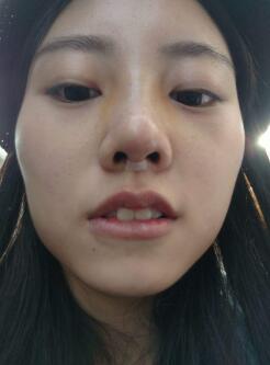 隆鼻術(shù)后的恢復(fù)期過程以及注意事項