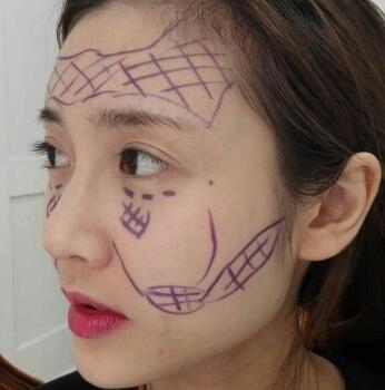 自體脂肪填充臉頰有風險嗎?