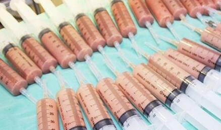 脂肪隆鼻術(shù)的果是怎樣的?