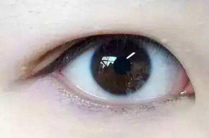 全切雙眼皮適宜人群