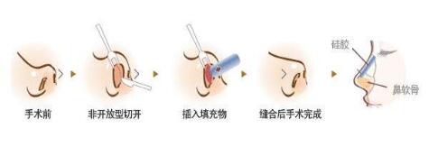 膨體隆鼻手術(shù)原理