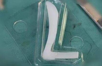 隆鼻材料到底應(yīng)該怎么選?