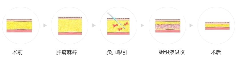 臀部吸脂手術的優(yōu)勢如下：