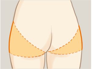 臀部吸脂手術的優(yōu)勢如下：