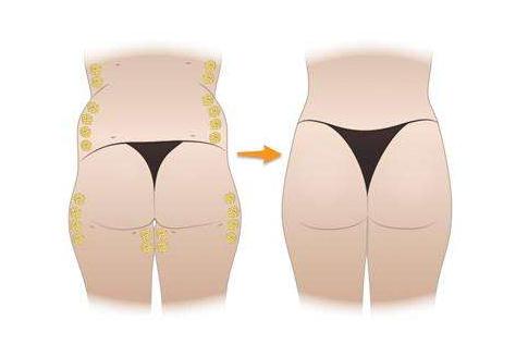 臀部吸脂手術術前該注意哪些呢?