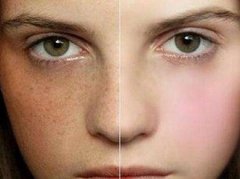 去黃褐斑多少錢？調節(jié)黃褐斑的價格費用詳情！