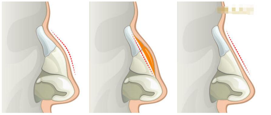 2019年駝峰鼻矯正價錢