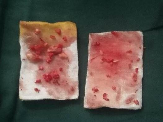 注射骨粉隆鼻的并發(fā)癥主要有以下三點：