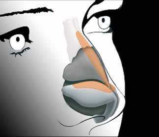 駝峰鼻是怎樣矯正的？