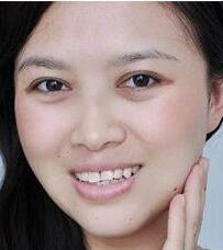 激光祛黃褐斑的優(yōu)勢(shì)