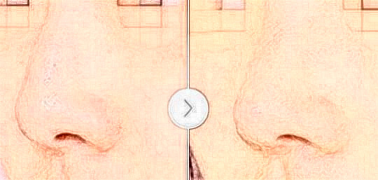 駝峰鼻矯正有后遺癥嗎？