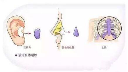 常見的隆鼻方式有以下幾種：