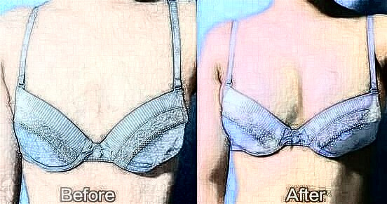 做妙桃假體隆胸務必注意的事項：