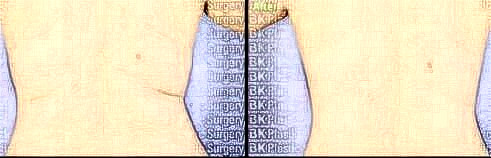 吸脂瘦后背果怎么樣？