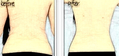 吸脂瘦后背果怎么樣？