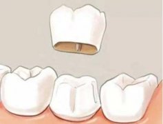 做美齒冠大概流程和步驟，手術(shù)的調(diào)節(jié)周期！