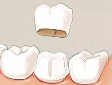 美牙冠是什么？