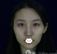 分享一組磨骨手術(shù)對比照片，還有親身感受經(jīng)歷