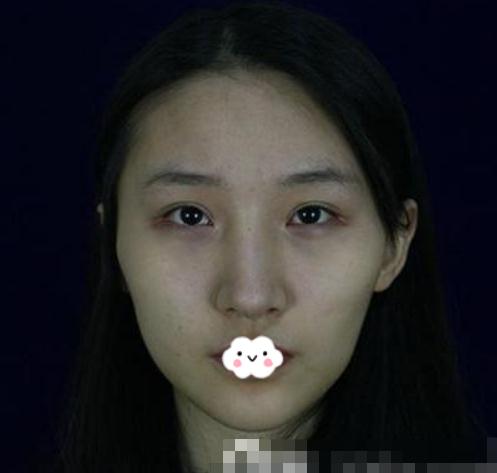 分享一組磨骨手術(shù)對(duì)比照片，還有親身感受經(jīng)歷！