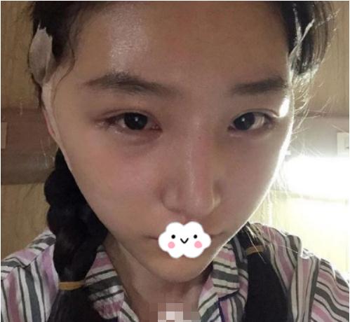 分享一組磨骨手術(shù)對(duì)比照片，還有親身感受經(jīng)歷！