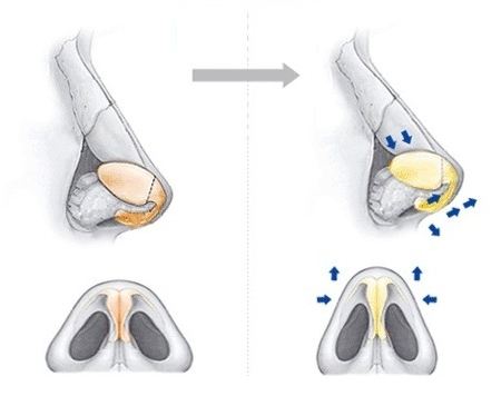 鼻尖成形術(shù)的優(yōu)點：