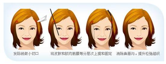 內窺鏡除皺術原理分析