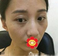 藍寶石激光祛斑來拯救我這個斑點女孩！