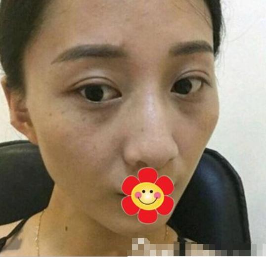 藍寶石激光祛斑來拯救我這個斑點女孩(圖)