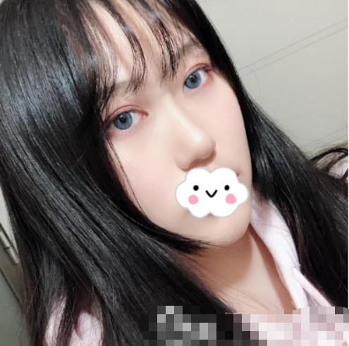 隆鼻術(shù)后第45天