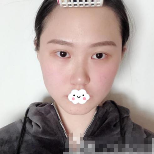 隆鼻手術(shù)術(shù)前