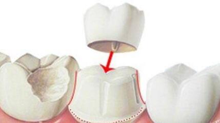 做美牙冠步驟：