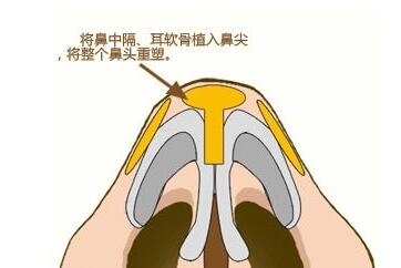 鼻尖成形術(shù)的原理