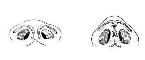 鼻尖成形術(shù)的原理