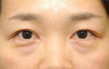 年紀(jì)輕輕就有眼袋？外切去眼袋手術(shù)真的應(yīng)該了！