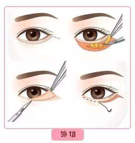 外切去眼袋手術(shù)的介紹