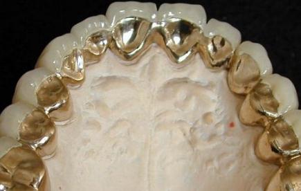 純鈦烤瓷牙的優(yōu)勢