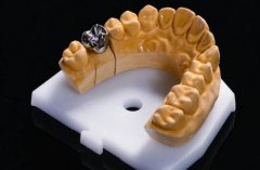 純鈦烤瓷牙的價格優(yōu)勢~這個材料還不錯！