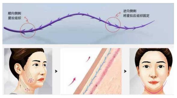 埋線除皺是什么？讓你遠(yuǎn)離皺紋沒(méi)煩惱！