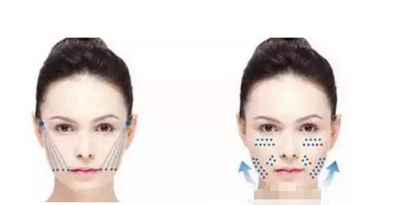 埋線除皺是什么?