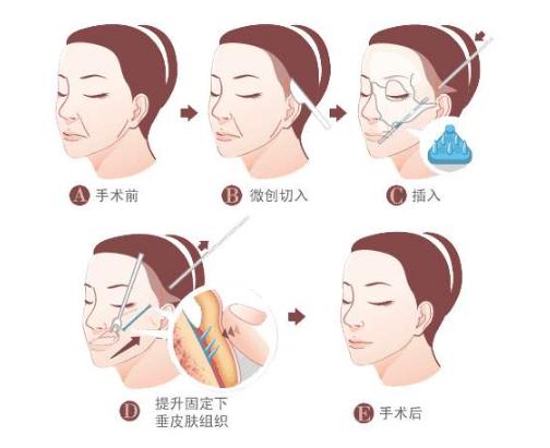 埋線除皺的注意事項(xiàng)