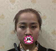 做完仿生隆鼻手術(shù)的果~顏值即正義！