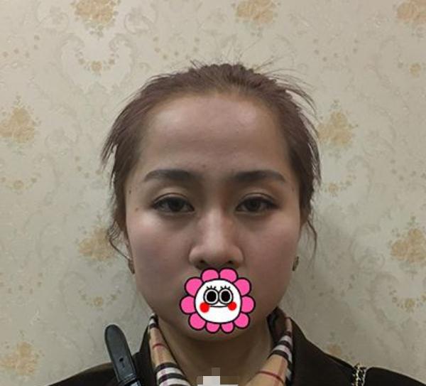 做完仿生隆鼻手術(shù)的果~顏值即正義！