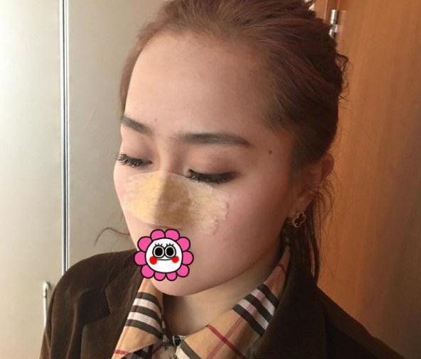 隆鼻術(shù)后第8天