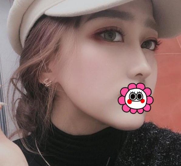 隆鼻術(shù)后第14天