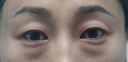 外切去眼袋手術(shù)的注意事項和護理措施