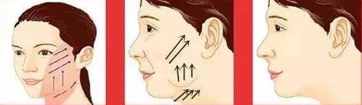 埋線除皺的優(yōu)勢(shì)