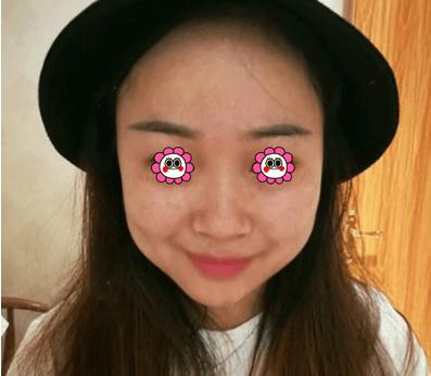 像素激光去痘做完后已經(jīng)6個月了！無暇肌膚！