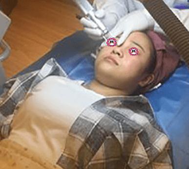 像素激光去痘術(shù)中